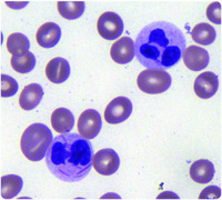 Mature neutrophils with Auer rods following treatment with all-trans retinoic acid for acute promyelocytic leukemia