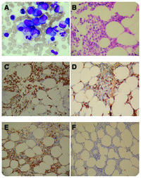 Immunoglobulin G4-positive plasma cell myeloma