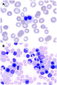 A case of benign Pelger-Huët anomaly