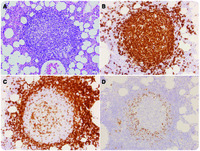 Early bone marrow involvement by mantle cell lymphoma