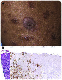 A window into cutaneous adult T-cell leukemia/lymphoma