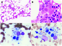Hemophagocytic lymphohistiocytosis associated with visceral leishmaniasis
