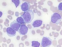 B-Prolymphocytic leukemia