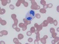 HIV-related myelodysplasia