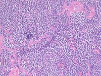 Warthin-Finkeldey giant cells 2