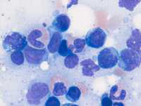 Adult T-cell leukemia/lymphoma cells (marrow)
