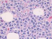 Dutcher bodies in myeloma