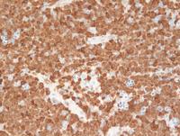 Cyclin D1-Blastoid MCL