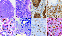 Cytokeratin-type intermediate filaments in a gastric myeloid sarcoma: a diagnostic pitfall