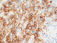 EBV+ Mucocutaneous Ulcer