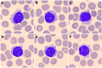 Lymphocytosis, villi, and nucleoli: a variant of hairy cell leukemia
