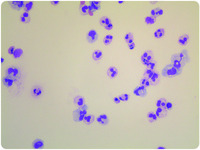 Apoptotic neutrophils in ascitic fluid