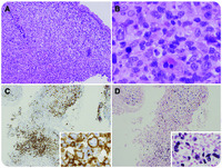 Epstein-Barr virus associated with a lymphoma-mimicking lesion of the uterine cervix