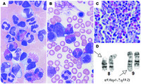 Unusual infant eosinophilia: myeloid neoplasm with FGFR1 abnormality