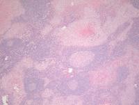 Langerhans cell Histiocytosis