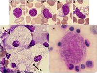 Morphology of Niemann-Pick type A metabolic storage disorder