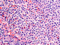 Langerhans cell histiocytosis lymph node