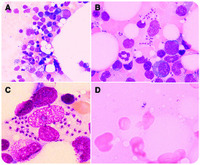 Pancytopenia caused by visceral leishmaniasis in a patient immunosuppressed after cancer therapy