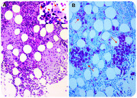 Disseminated MAC infection with marrow noncaseating granuloma