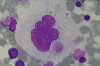 Emperipolesis in megakaryocyte