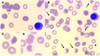 Plasma cell leukemia revealing a G6PD deficiency