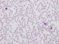 Atypical Hemolytic Uremic Syndrome