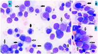 Myelodysplastic syndrome with excess blasts-2 associated with erythroid predominance