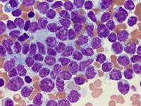 Bone marrow infiltration at 100x