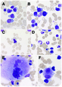 IgD κ multiple myeloma and myelodysplastic syndrome