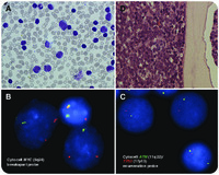 DLBCL-Richter transformation in CLL