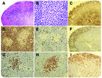 DLBCL-Richter transformation in CLL