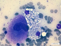Reactive Foamy histiocytes