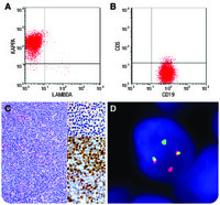 CD5-negative mantle cell lymphoma of the breast