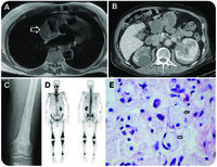 Erdheim-Chester disease presenting as bradycardia in an elderly man