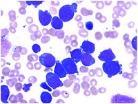 Myeloid leukemia associated with Down syndrome