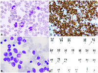 Peripheral eosinophilia as the first manifestation of B-cell acute lymphoblastic leukemia with t(5;14)(q31;q32)