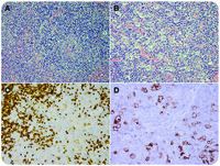 Classical Hodgkin lymphoma and Castleman disease: a rare morphologic combination