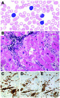 Broken heart by T-prolymphocytic leukemia