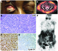 Lacrimal gland and extensive subcutaneous tissue involvement by mantle cell lymphoma