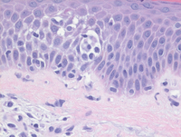 Mycosis Fungoides 1