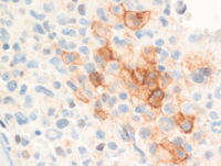 Mast-cell-Leukemia