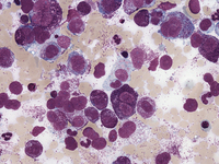 Mast-cell-Leukemia