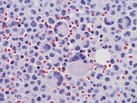 Mast-cell-Leukemia
