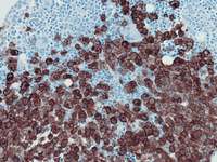 Mast-cell-Leukemia