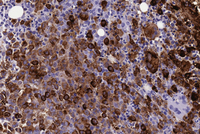 Mast cell Leukemia