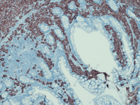 CD25-IHC-GI-Biopsy