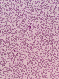 HEREDITARY ELLIPTOCYTOSIS