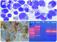 MPO-negative inclusions and Auer rod–like structures in a case of acute myeloid leukemia with t(8;21)