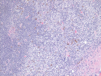 Lymph node with Dermatopathic Lymphadenitis