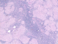 Sarcoidosis granulomas